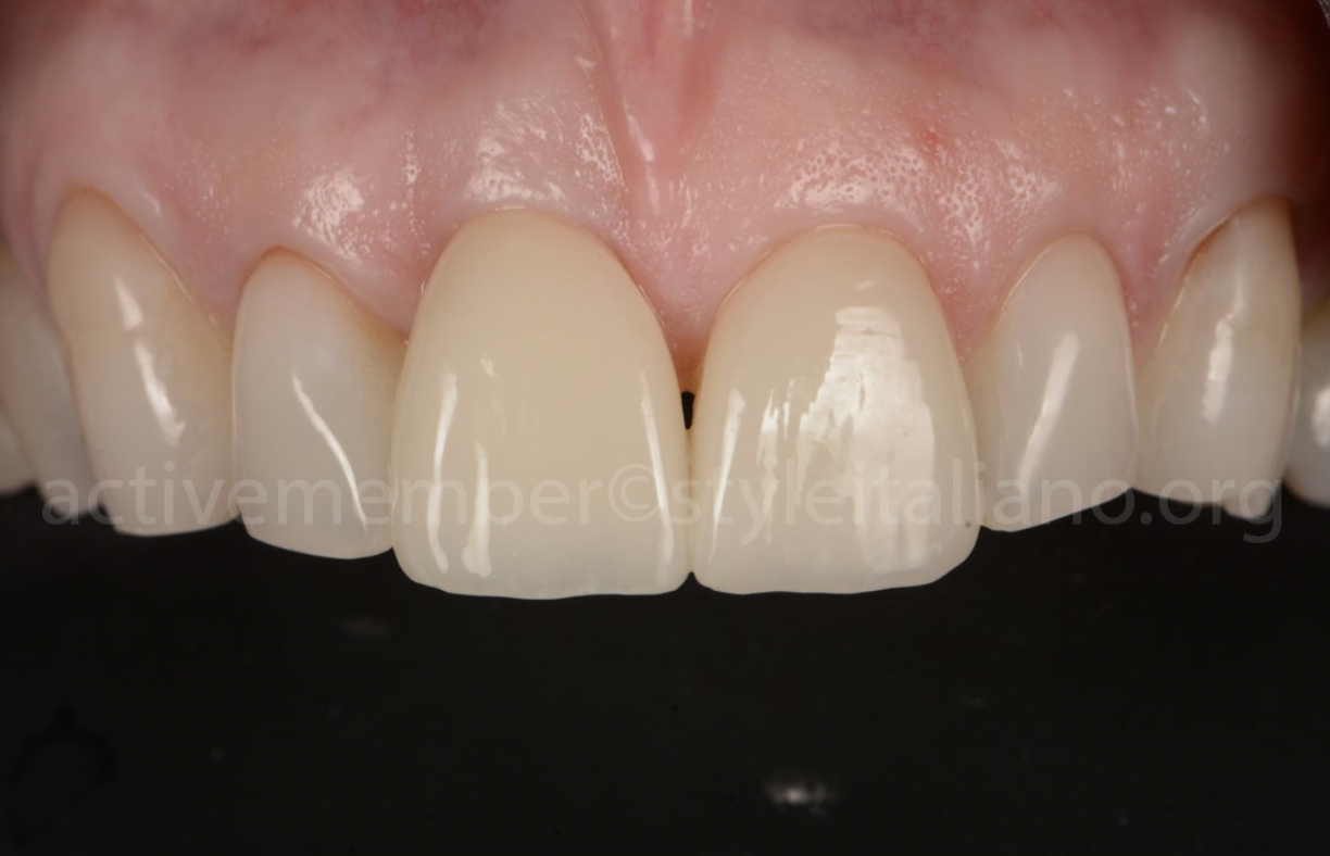 Phục hình thẩm mỹ răng cửa bằng sự kết hợp giữa Veneer và implant